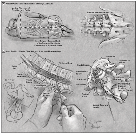 side effects after lumbar puncture