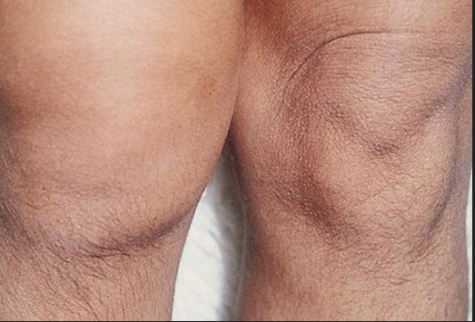 SGEM#39: Weak in the Knees (Diagnosis of Septic Joint)