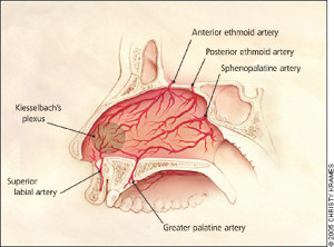 SGEM#53: Sunday, Bloody Sunday (Epistaxis and Tranexamic Acid) | The