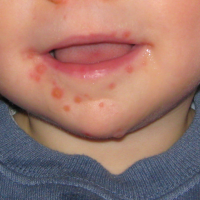 SGEM#81: Sore Mouth (Lidocaine for Oral Ulcers)
