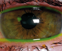 SGEM#83: In Your Eyes (Topical Tetracaine for Corneal Abrasions)