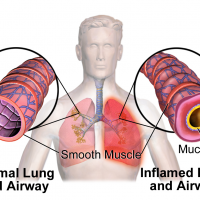 Asthma corticosteroids inhaled