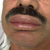 SGEM#110: I Saw the Signs of Angioedema