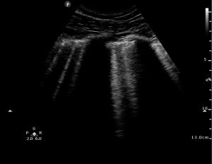 SGEM#119: B-Lines (Diagnosing Acute Heart Failure With Ultrasound ...