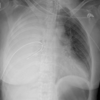 SGEM#129: That Chest Tube…She’s a Beauty