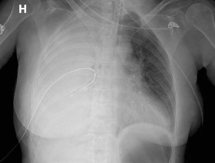 Chest Tube Placement X Ray