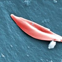 SGEM#166: Which febrile child with sickle cell disease should get a chest x-ray?