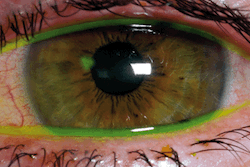 SGEM#83: In Your Eyes (Topical Tetracaine For Corneal Abrasions) - The ...