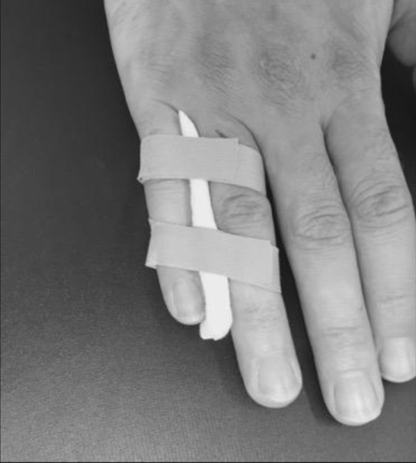 SGEM273 My Buddy (Tape) for Boxer’s Fractures The Skeptics Guide to