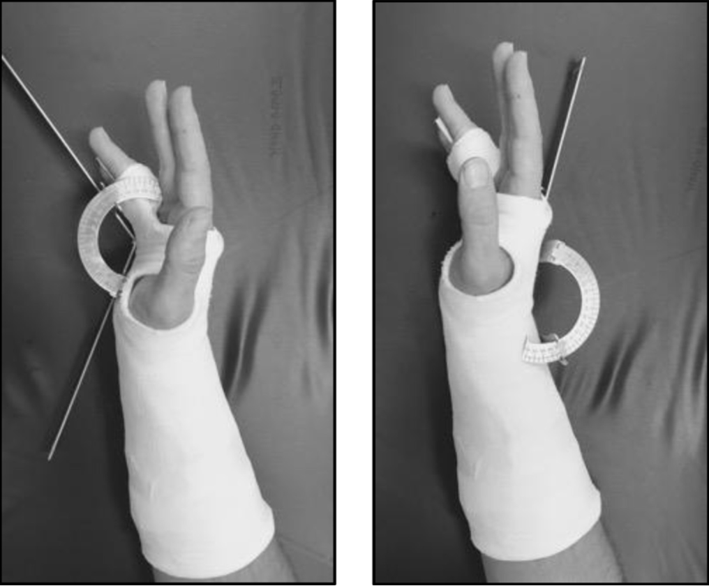 SGEM273 My Buddy (Tape) for Boxer’s Fractures The Skeptics Guide to Emergency Medicine